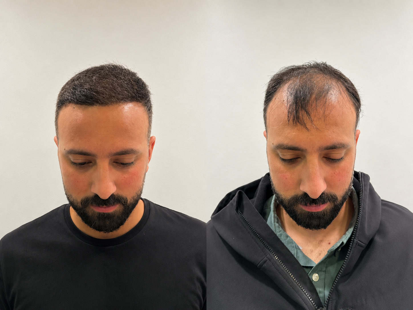 Before and after hair transplant results at Apollo Hair Care Center