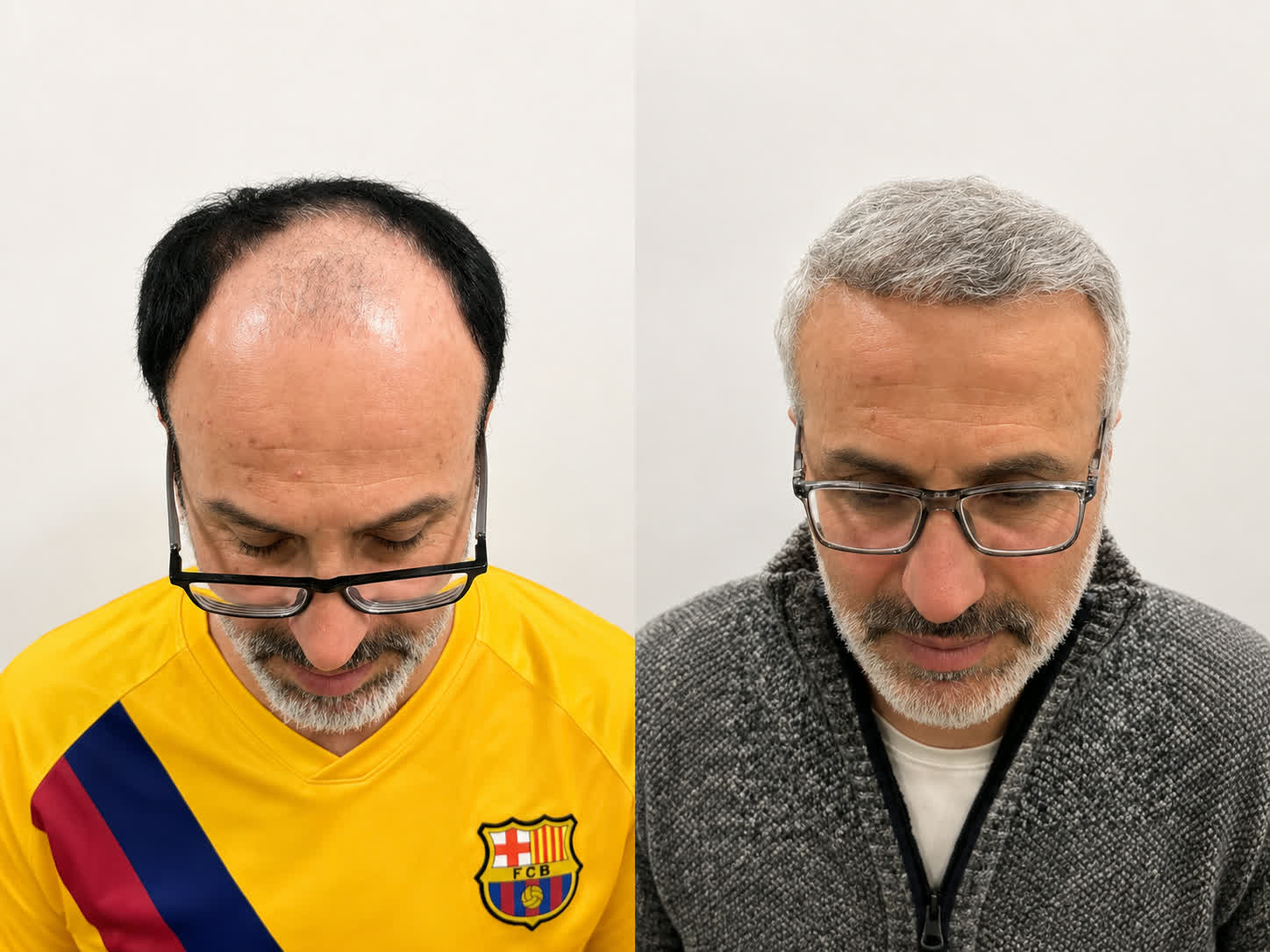 Before and after hair transplant results at Apollo Hair Care Center