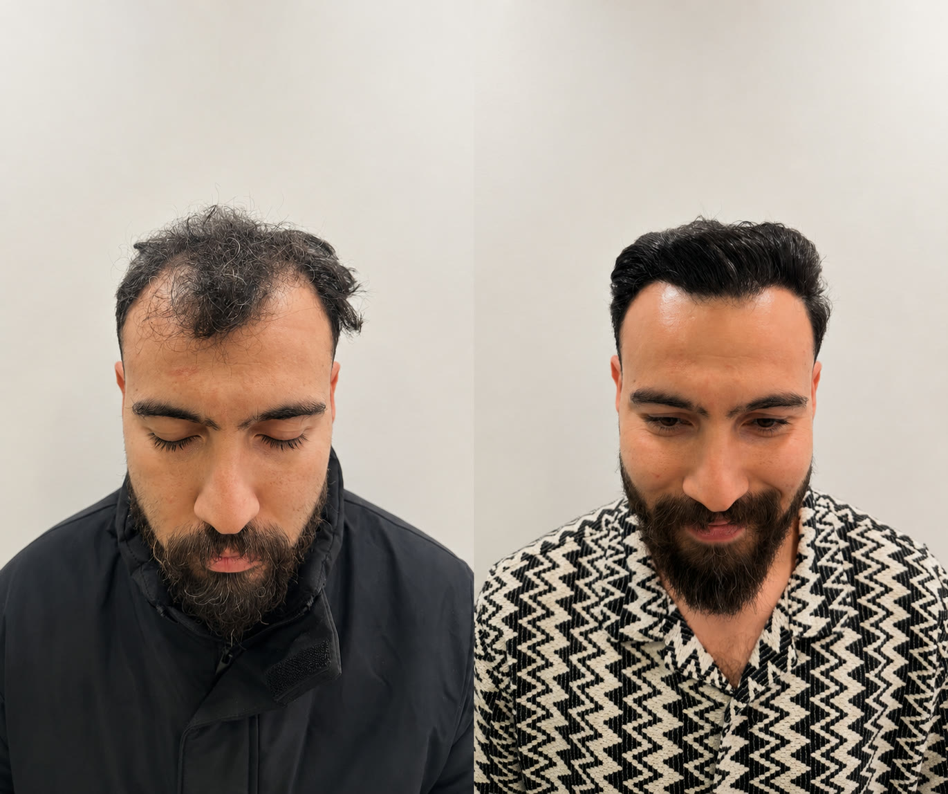 Before and after hair transplant results at Apollo Hair Care Center